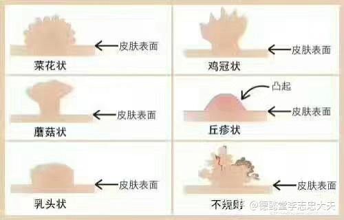 病毒疣的种类有哪些?如何治疗?