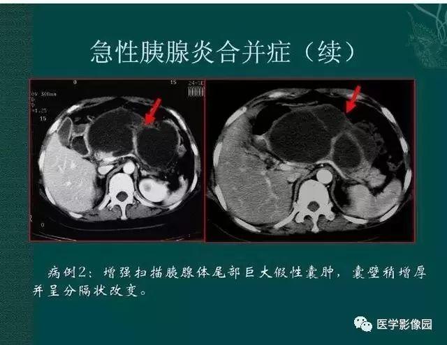 急性胰腺炎ct评价