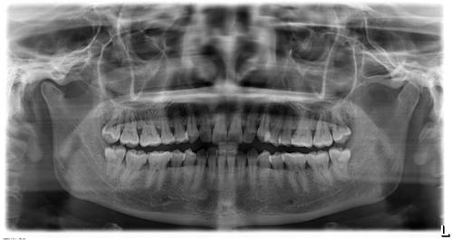我的智齿长得很正常,和普通牙齿一样高,一样垂直,只是
