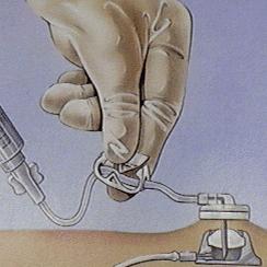 聚焦临床输液港一种更体贴的输液方式反复使用可保留510年