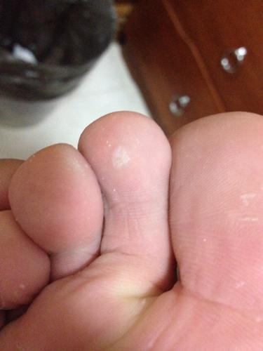 脚趾上白色的是什么?用手戳它就疼.不碰它没事