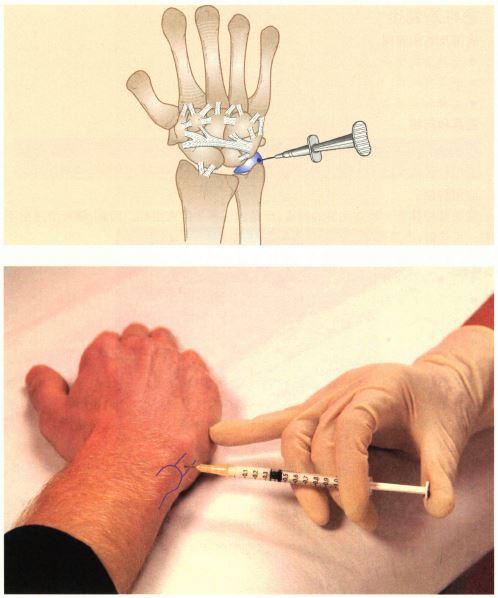 《镇痛注射技术图谱》——上肢注射技术:下尺桡关节和