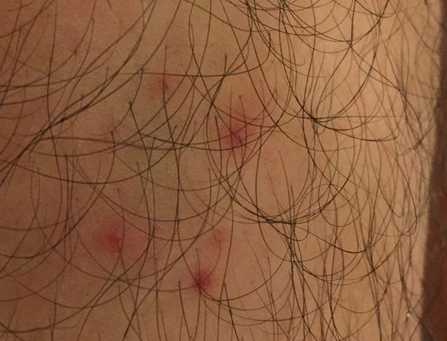 毛囊炎经常复发我们该怎么办