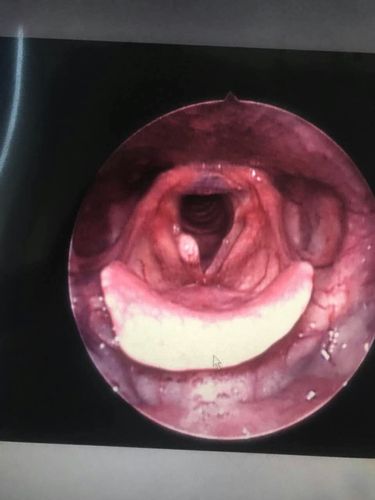 电子纤维喉镜下见声带息肉