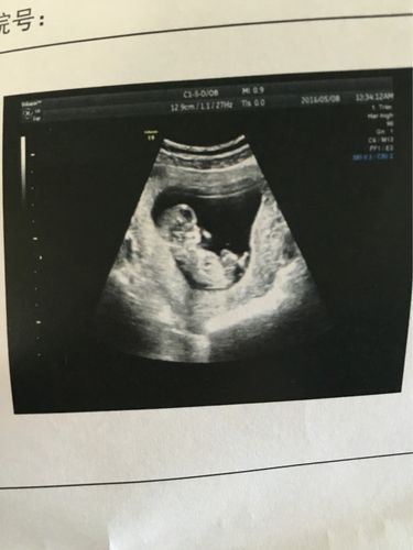 好感动,彩超中第一次和宝宝的近距离接触