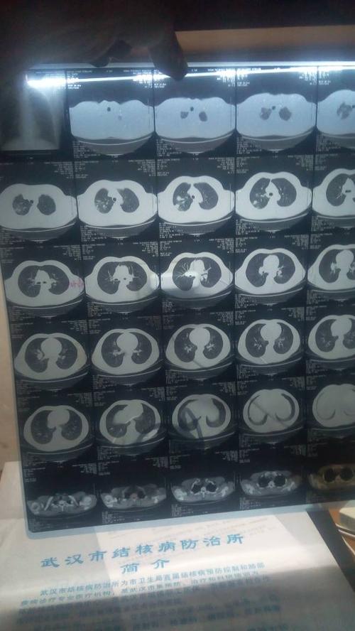 这种肺部ct图是肺炎还是肺结核呀?