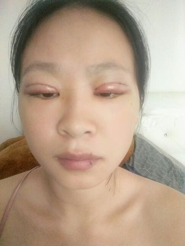 刚做完双眼皮的第二天,为什么我只能睁开半边眼,是什么原因?