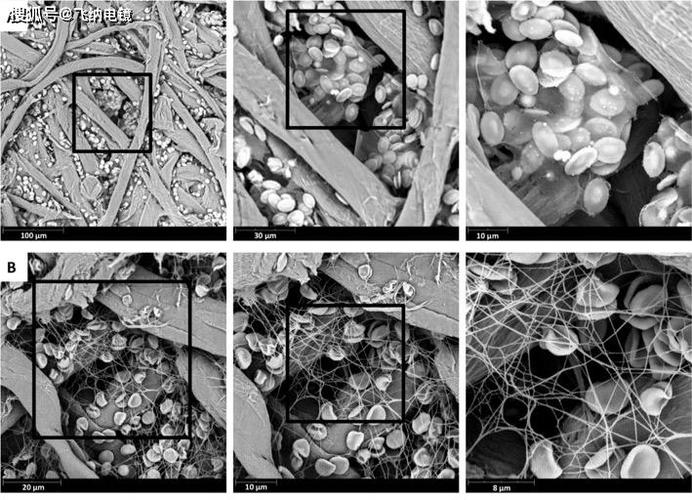 扫描电镜揭秘最隐蔽的杀手——血栓