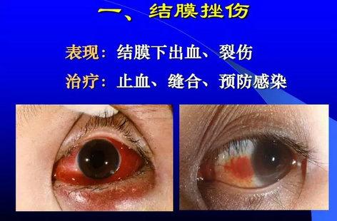 眼外伤的分类及处理