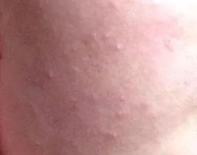 小五护肤:脸上有"逆光疹"怎么护理?造成逆光疹的原因有哪些?