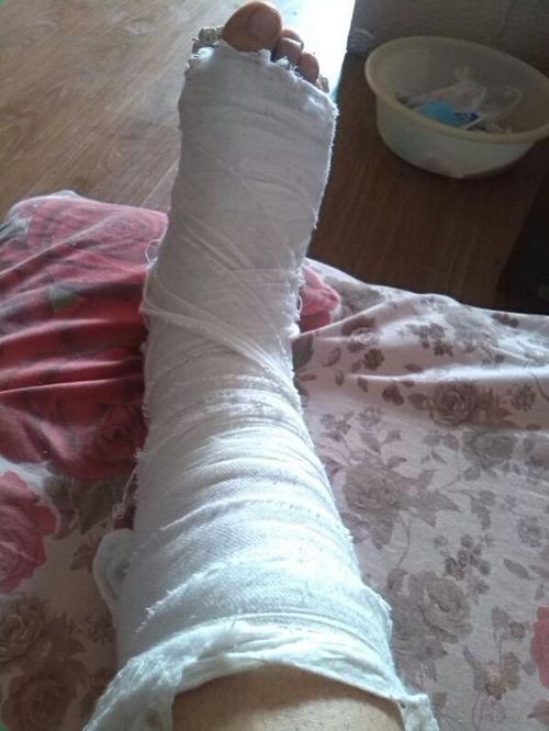 骨折腿托_polin骨折_全身骨折