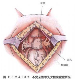 又称男性女性化,或睾丸女性化综合征.