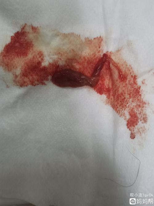 怀孕8个月有宫颈息肉出血,今天早上息肉突