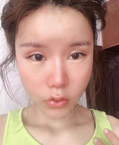厚唇改薄术后6天_m唇手术术后6天_唇形矫正术后6天_唇型美化术后6天