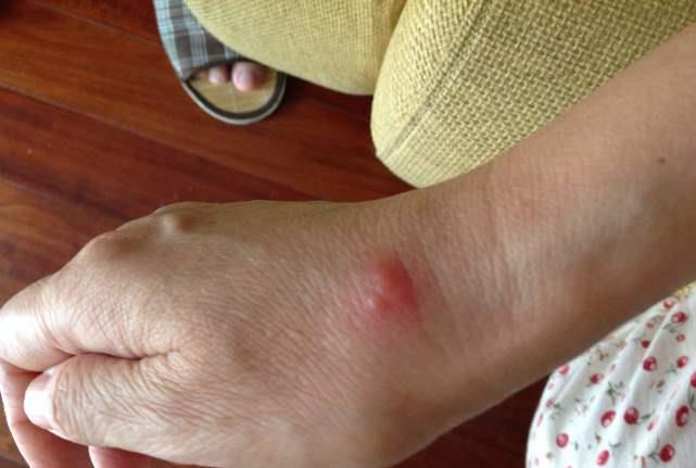 手上若出现这3种迹象,说明糖尿病可能要来了!