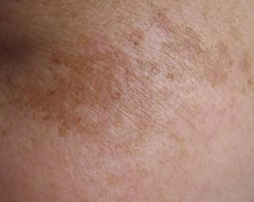 黄褐斑根治方法有哪些