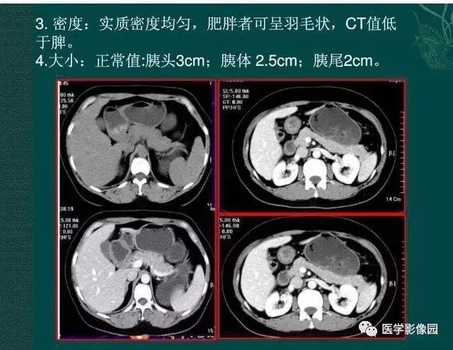 急性胰腺炎ct评价