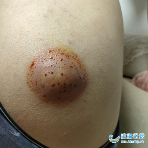 救命啊!屁股上长了个巨大的脓包,看过医生了,也没用