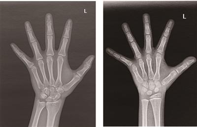 骨骺线完全闭合的20岁成年人骨龄片(左)与骨骺线未闭合的7岁儿童骨龄