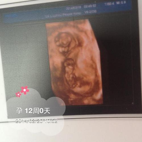 多囊输卵管堵塞,经历促排,造影,后选择试管婴儿