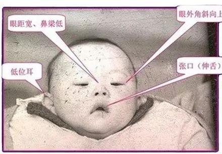 唐氏儿"爱找"这2类孕妈,能帮你"躲"开的这些方法,你要