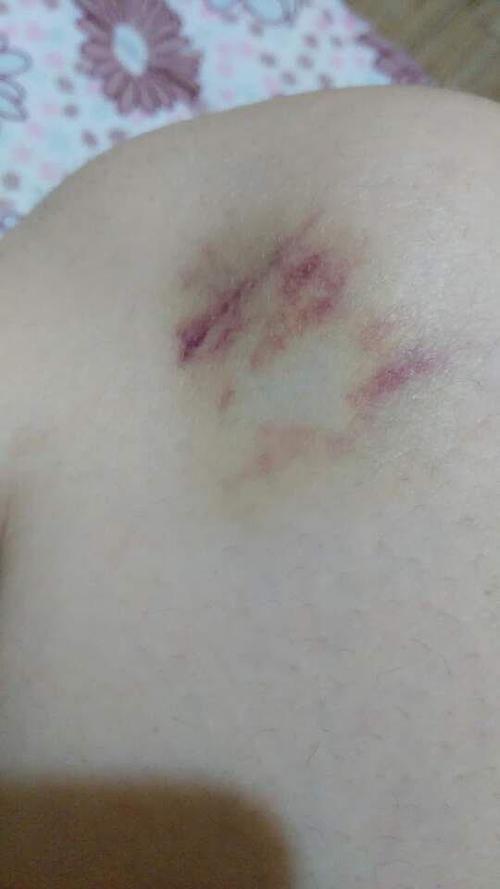 其妙的淤青,前几天还是青的,现在好恐怖,明明没有磕到呀,泪奔,身体太