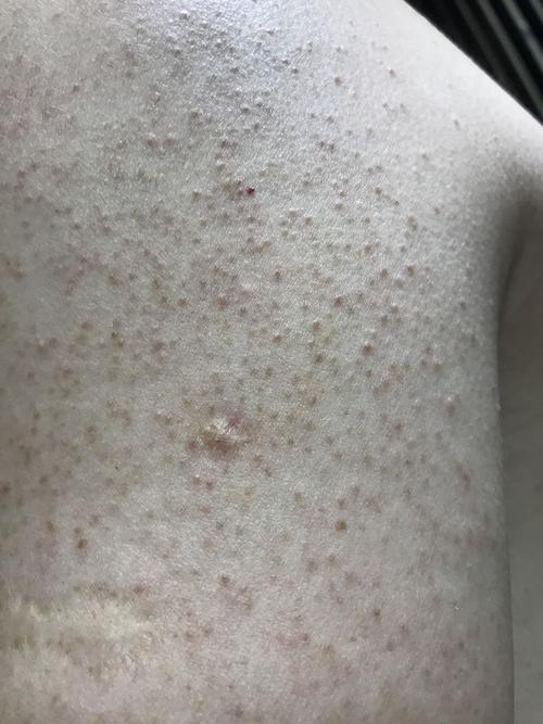 不要说毛囊角化症