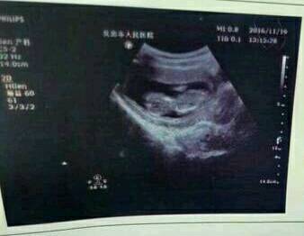 nt检查会在11周~13周,因为患唐氏症的胎儿会有皮下积水的情况出现,此