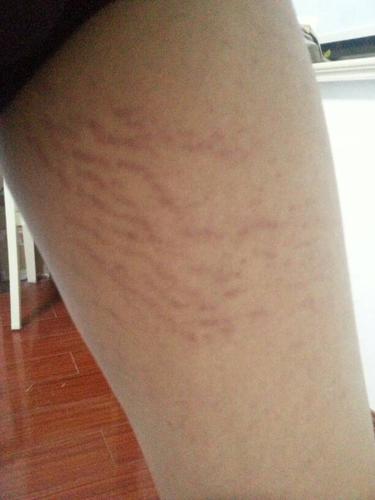 大腿内侧有这样对我纹路是什么东西.