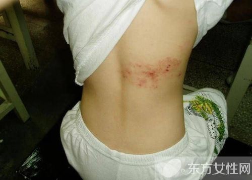 蛇盘疮的最佳治疗方法 这些早期症状需注意