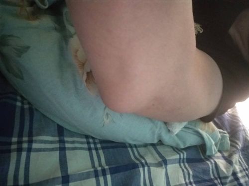运动后肘关节处忽然鼓起一个大包,但是也不疼,按的话会疼,是怎么回事