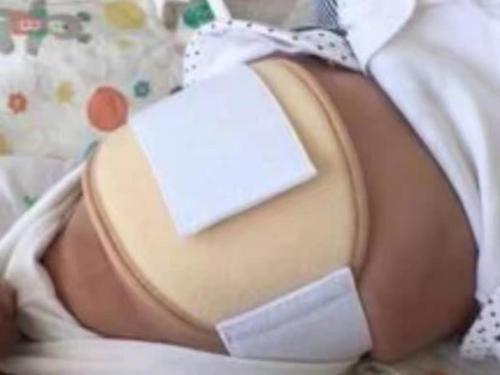 阳光森林的故事儿童课堂—疝气