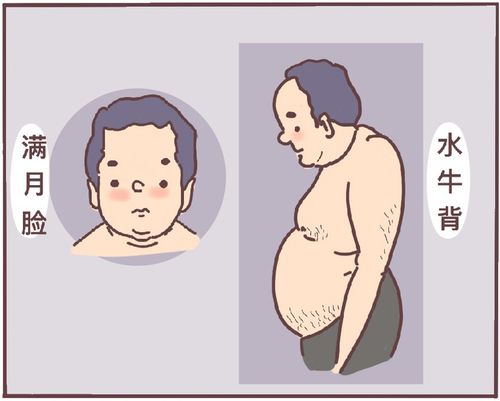 疾病特点:"满月脸,水牛背",是内分泌疾病库欣综合征的典型症状,顾名