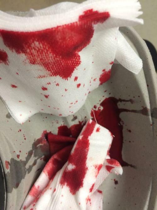 沾满血的纱布
