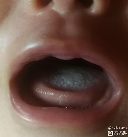 三月龄男宝宝,舌头白色的是鹅口疮还是奶垢