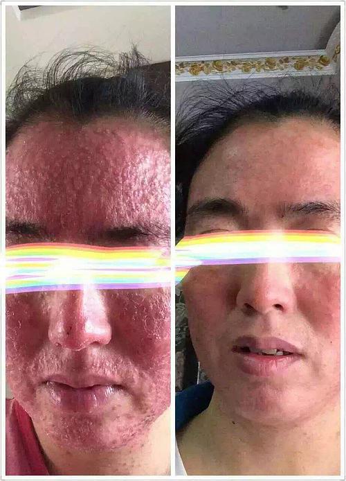 激素脸终于治好了