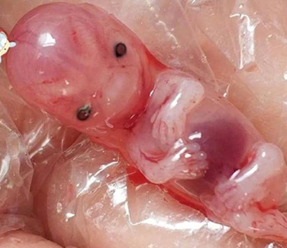 你见过60天的胎儿吗?药流后完整模样曝光,网友:太让人