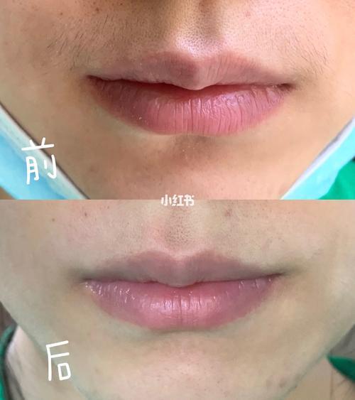 激光脱唇毛3_脱唇毛_十一去哪玩_激光脱毛_去唇毛_美妆_医美整形