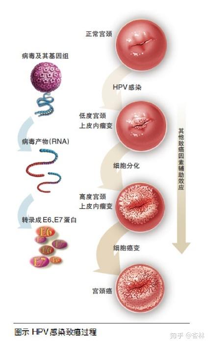 hpv感染与宫颈癌专述