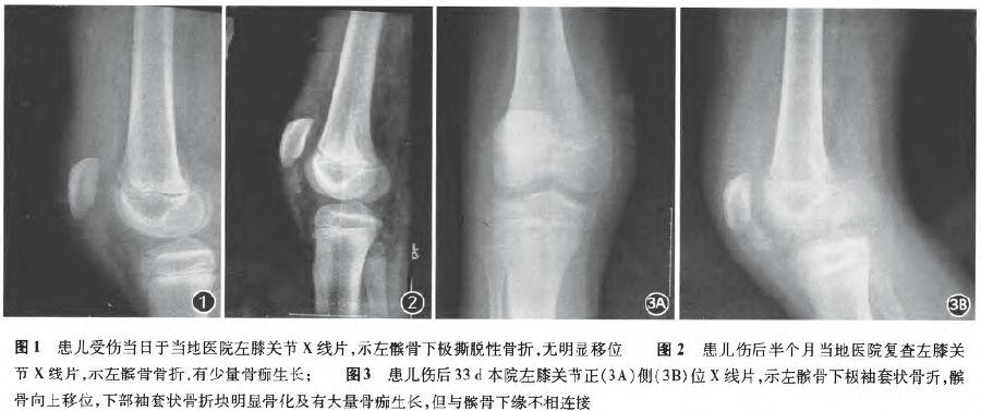 髌骨向上移位,下部袖套状骨折块明显骨化及有大量骨痂生长,但与髌骨下