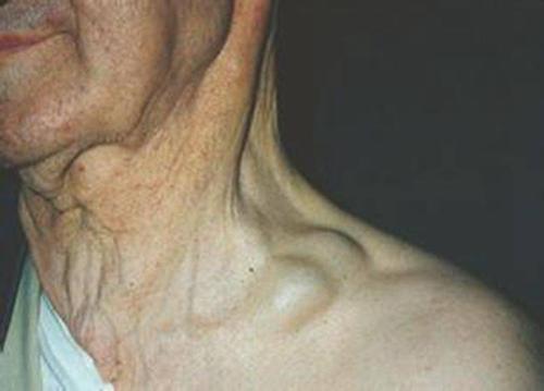 淋巴瘤是一种比较可怕的恶性肿瘤.