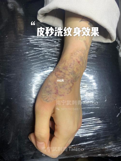 南宁洗纹身效果图_纹身_tattoo怎么样_皮秒_南宁洗纹身_美妆_医美整形