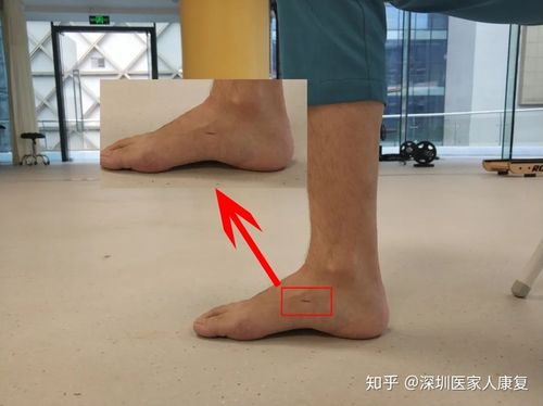 1,首先找到足舟骨,用手摸到足舟骨微微凸起的位置用细笔标出一条横线