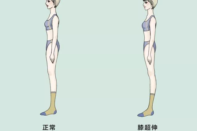 什么是膝超伸?你知道吗?如何改善"修正腿型",推荐3个动作