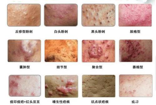 怎么解决痤疮问题?