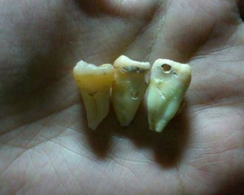 长智齿为什么会疼?碰到这种情况赶快拔掉