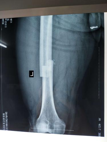 腹胀等伴随症状,未做特殊处理,随来我院就诊,门诊拍片示:左股骨干骨折