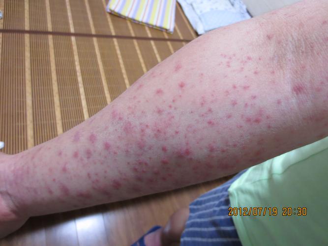 过敏性皮炎 药疹?