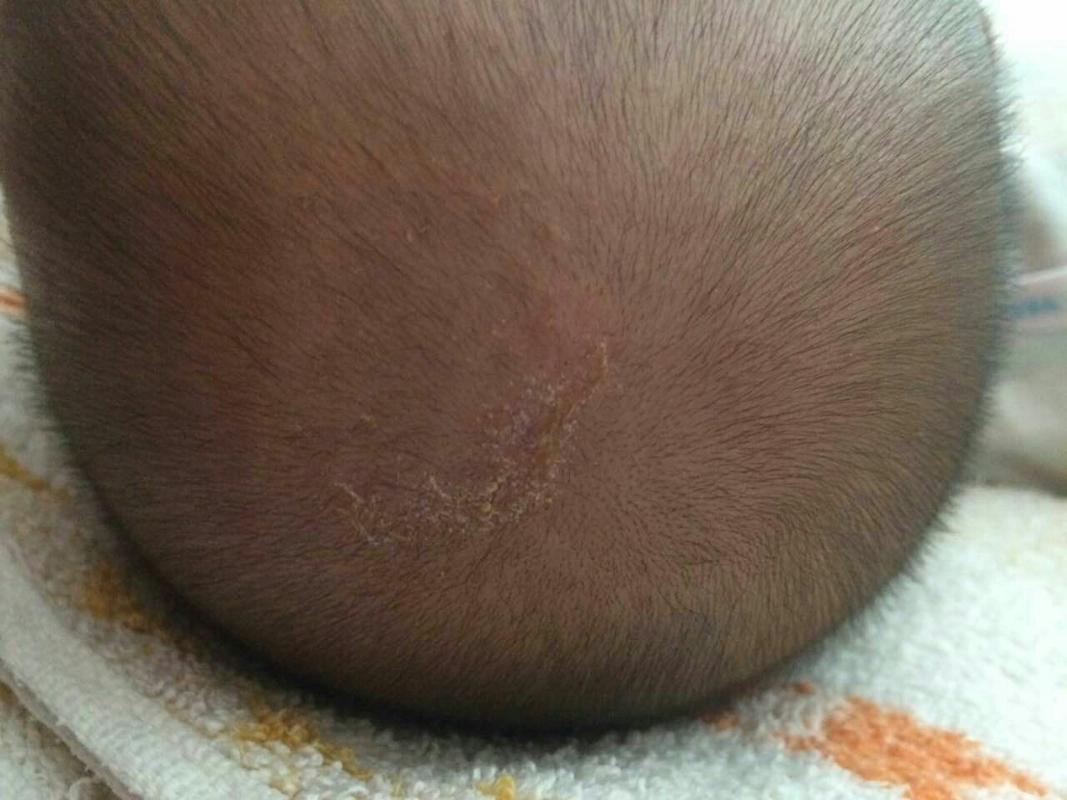 宝宝头上长了东西,自己会结痂的,好了又长.麻烦帮忙看