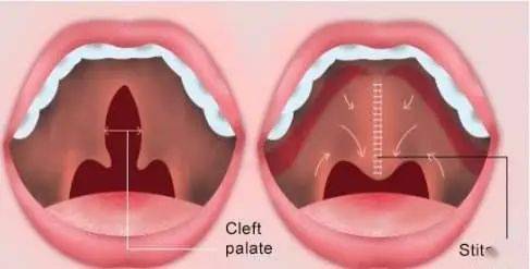 腭裂是指患儿口腔里的上腭部(俗称天堂或上堂)出现裂隙.